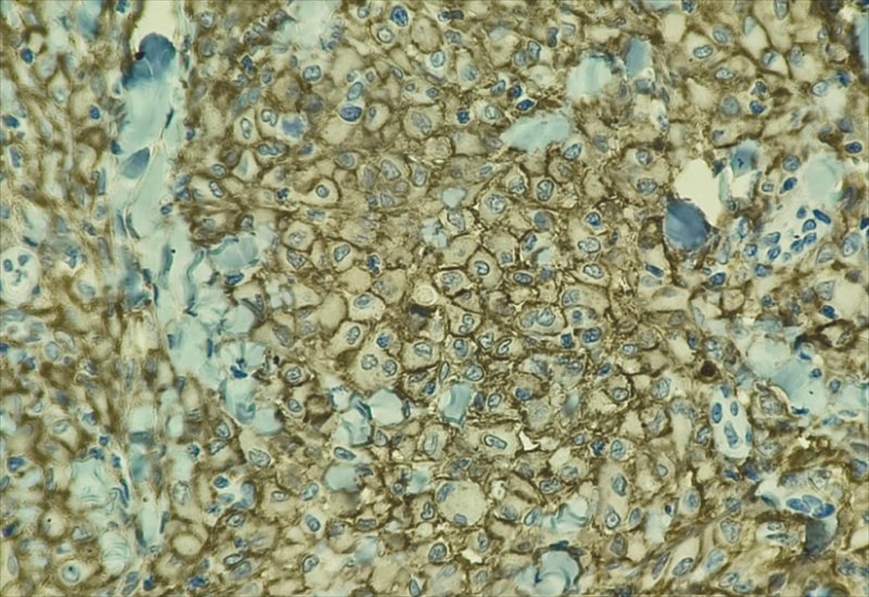 Lâmina de imuno-histoquímica com marcação acastanhada